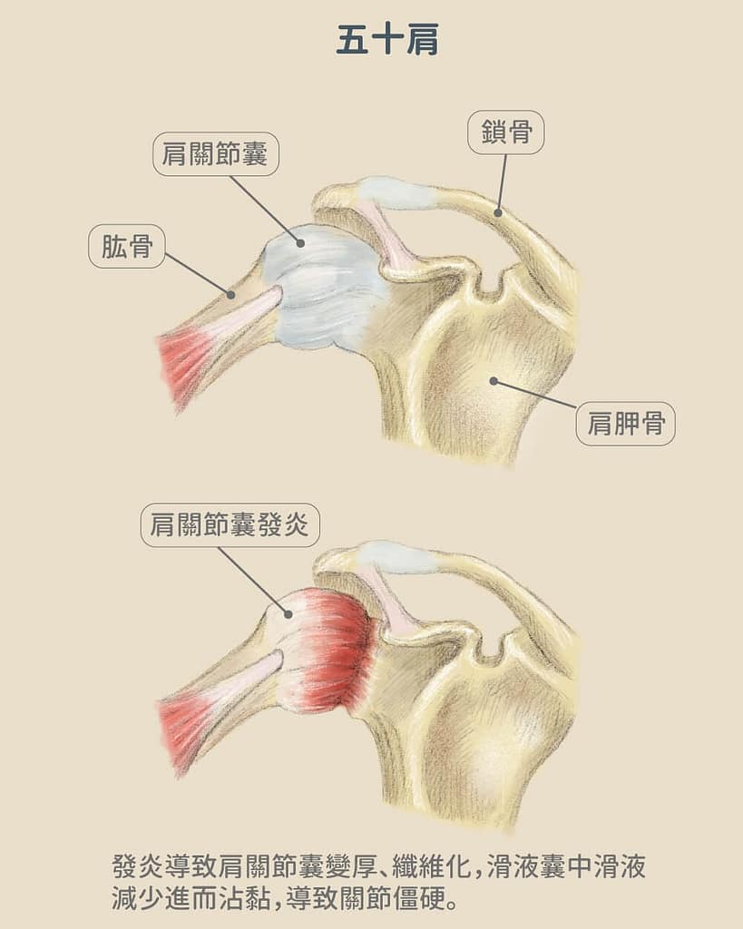 物理治療介入改善五十肩 - 沾黏性肩關節囊炎 五十肩解剖圖 819x1024